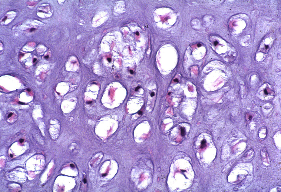 Pathology Outlines Enchondroma 5260